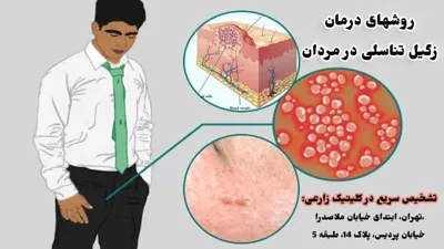          درمان قطعی زگیل تناسلی در کشور