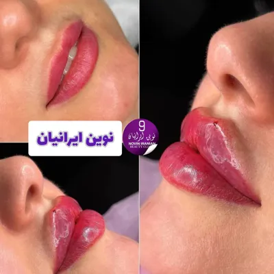 تزریق فیلر لب در کلینیک زیبایی