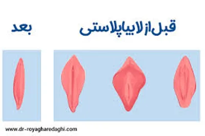 لابیاپلاستی با لیزر در خرم آباد