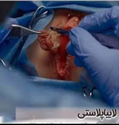 متخصص عمل لابیاپلاستی در خرم اباد