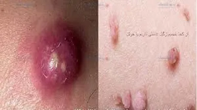 نوبت اینترنتی درمان زگیل تناسلی در خرم اباد