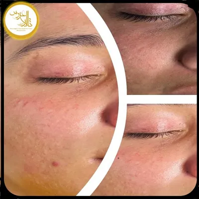 پاکسازی پوست در کرمان