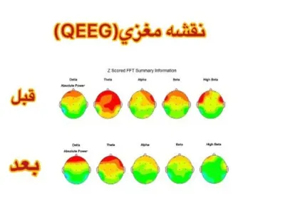 نتیجه درمان اختلالات افسردگی قبل و بعد

چکاب کامل در منزل 