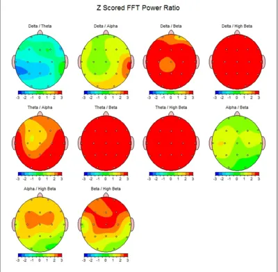 نقشه ی مغزی داری وسواس و افسردگی شدید

و بهبود در تیم چکاب در منزل 