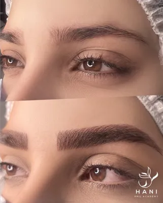 مزایای میکروبلیدینگ
