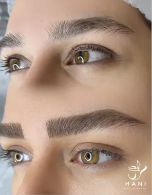 تکنیک های میکروبلیدینگ