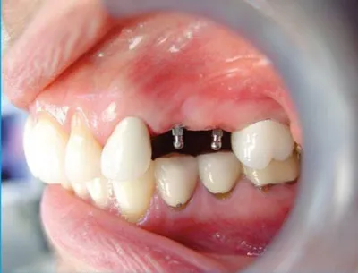 مرکز تخصصی ایمپلنت قسطی در فولادشهر