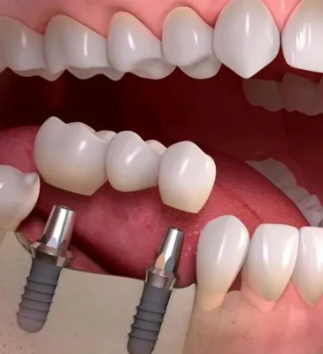  ایمپلنت قسطی در فولادشهر