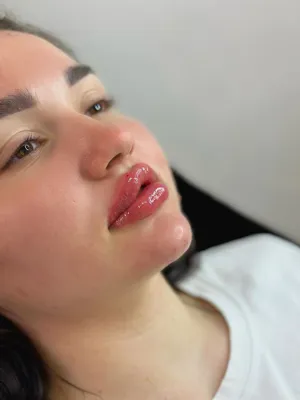 بعد از تزریق