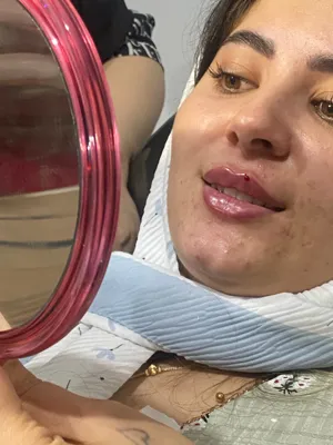 تزریق فیلر لب