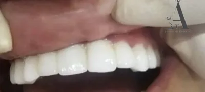 روکش دندان