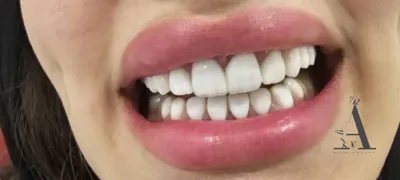 لمینت دندان