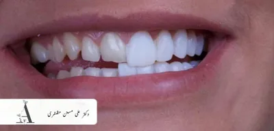 لمینت در تهران