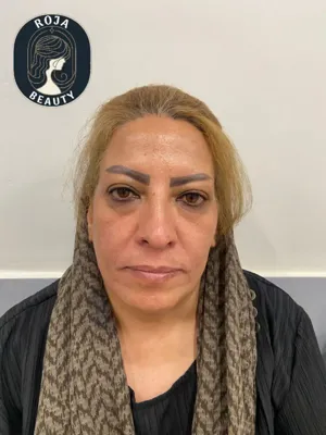 قبل ازتزریق فیلر خط خنده و کانتورینگ 