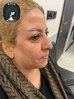 قبل ازتزریق فیلر خط خنده و کانتورینگ 