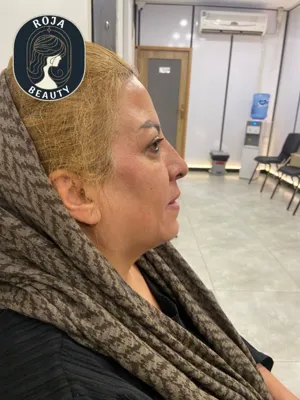 قبل ازتزریق فیلر خط خنده و کانتورینگ 