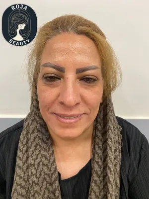 قبل ازتزریق فیلر خط خنده و کانتورینگ 