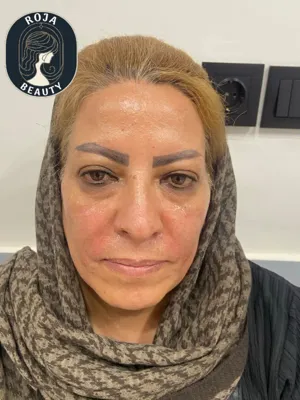 بعد از تزریق فیلر خط خنده و کانتور صورت  