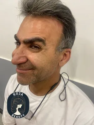 قبل از فیلر و بوتاکس 