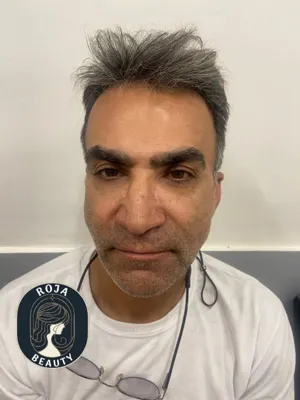 قبل از فیلر و بوتاکس 