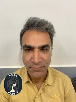 بعد از فیلر و بوتاکس 