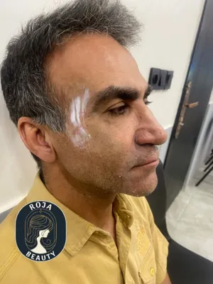 بعد از فیلر و بوتاکس 