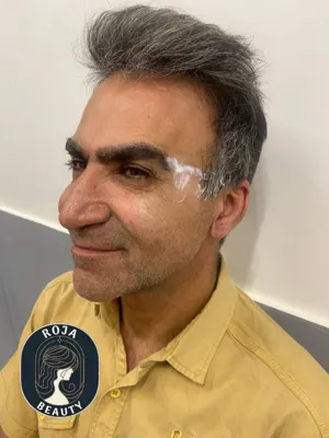 بعد از فیلر و بوتاکس 