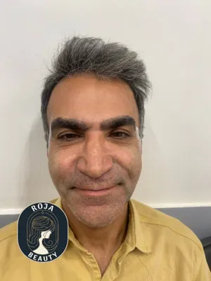 بعد از فیلر و بوتاکس 