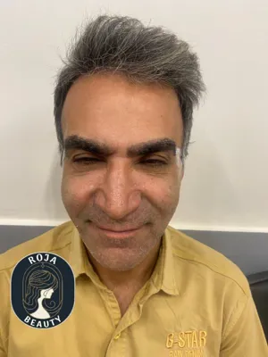 بعد از فیلر و بوتاکس 