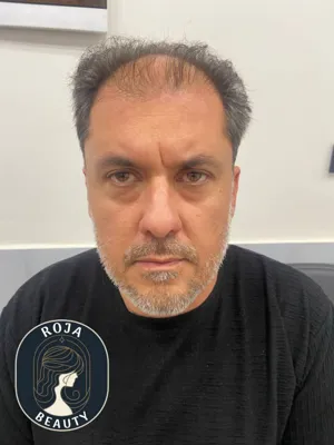 تزریق بوتاکس 