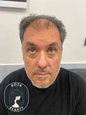 تزریق بوتاکس