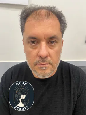 تزریق بوتاکس