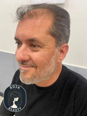 تزریق بوتاکس