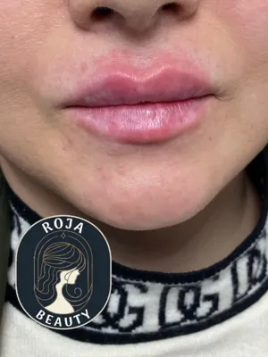 فیلر لب روژا بیوتی