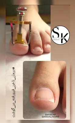 آموزش خارج کردن ناخن فرورفته در گوشت در آموزشگاه کاشت ناخن در کرمان