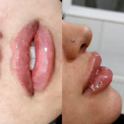 تزریق ژل لب در شاهین شهر