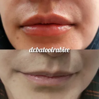 تزریق ژل شاهین شهر