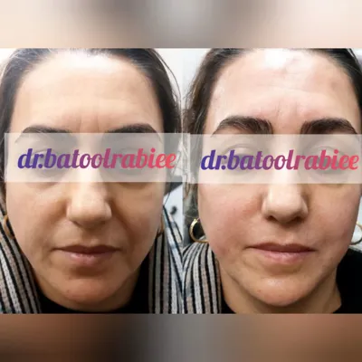 تزریق فیلر در شاهین شهر