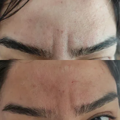 تزریق ژل در شاهین شهر