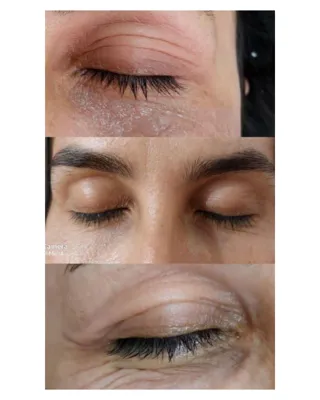 تزریق ژل لب شاهین شهر