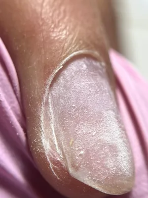 ترمیم کاشت ناخن