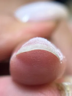 ترمیم ناخن شکسته