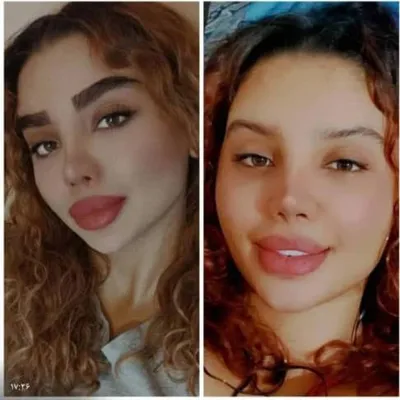 کاشت ابرو در تهران