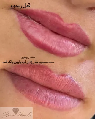 پاک کردن تتو لب