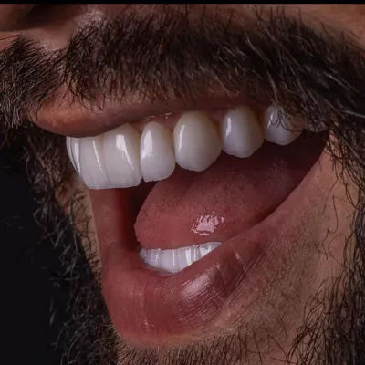 ایمپلنت دیجیتال 