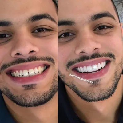 ایمپلنت دیجیتال 