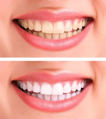 ایمپلنت دیجیتال 