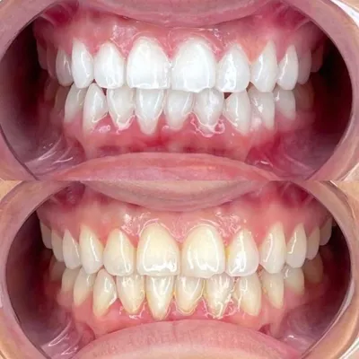 ایمپلنت دیجیتال 