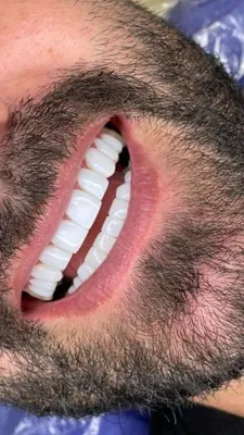 ایمپلنت دیجیتال 