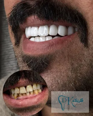 ایمپلنت دیجیتال 